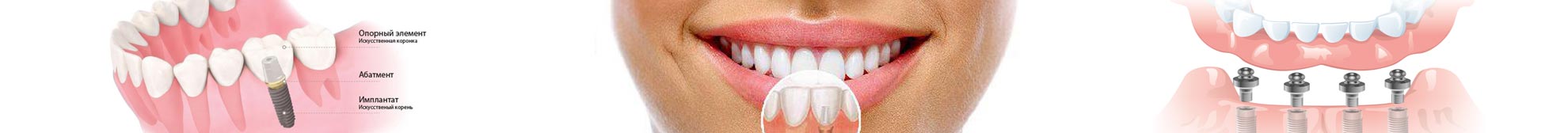 Имплантология - Клиника эстетической стоматологии 